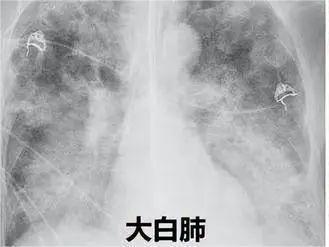 “大白肺”危及生命，国家认定的特效药清肺排毒汤去了哪里